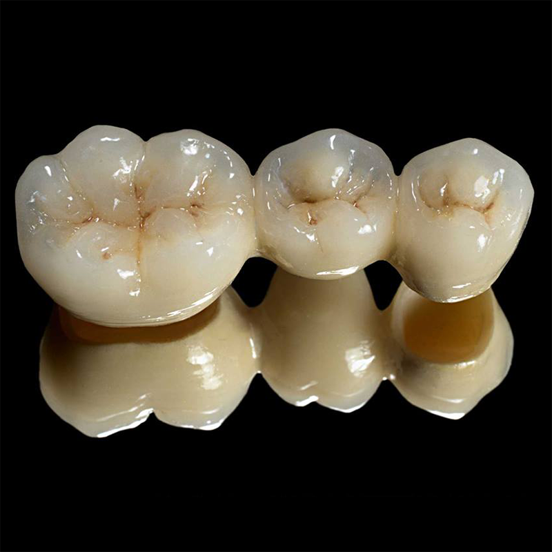 Zirconia-Bridge